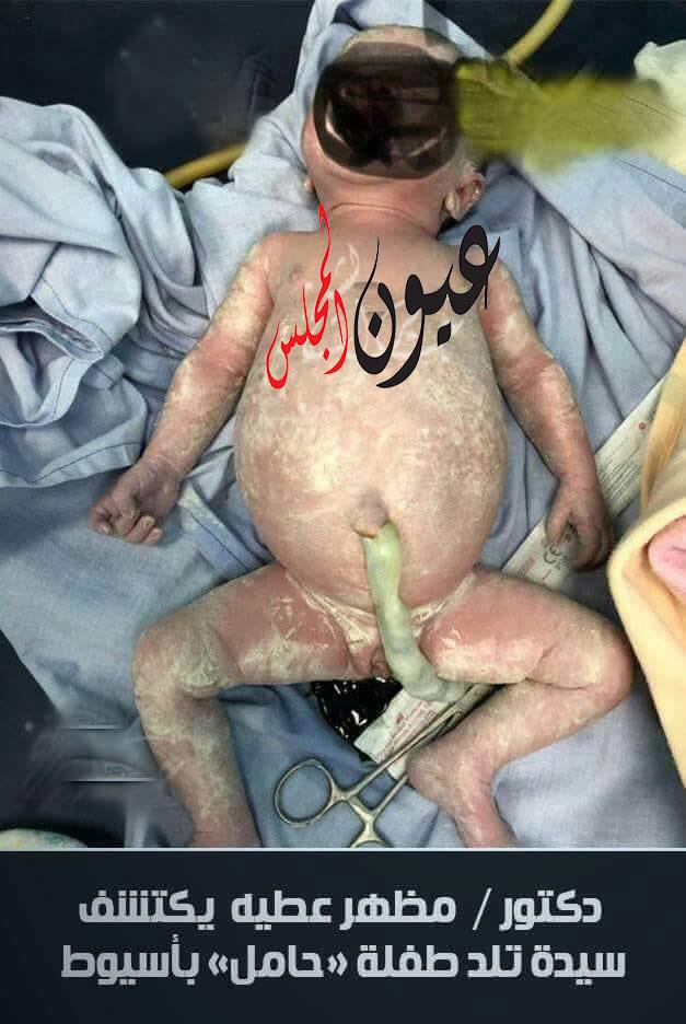 سيدة تلد طفلة «حامل» بأسيوط..!