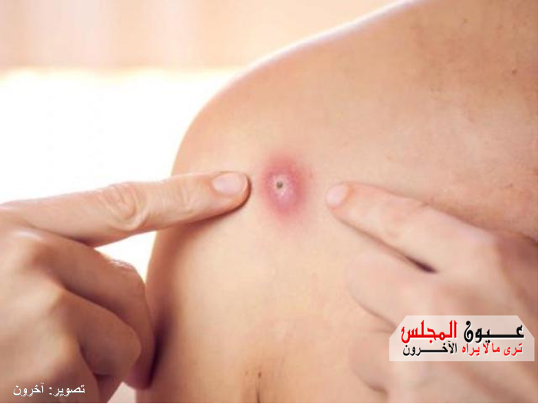 إقليم شرق المتوسط يسجل 35حالة إصابة بجدري القرود