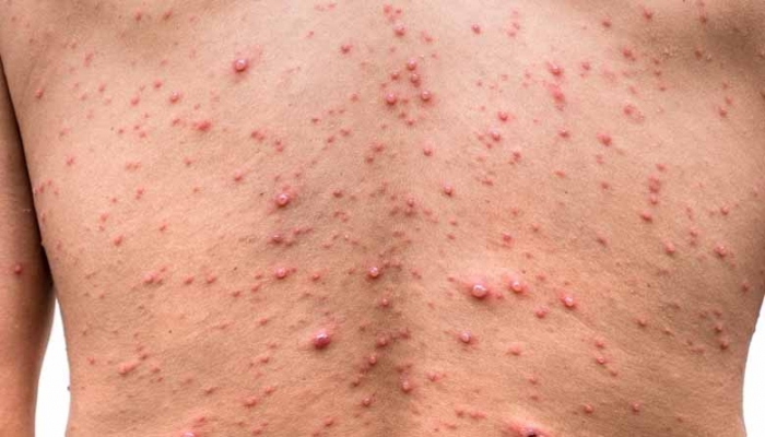 جدري القرود يغزو انجلترا