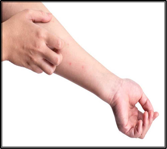 بكتريا آكلة لحوم البشر تصيب سيدة بريطانية.. تعرف على التفاصيل