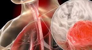 تعرف على.. علاج سرطان المريء وطرق علاجه