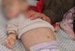 بسبب المجاعة والجفاف.. وفاة الطفلة جنان السكافي بمستشفى الرنتيسي بغزة
