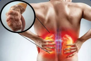 لن تصدق.. مشروب واحد قبل النوم يساهم في حماية الكلى